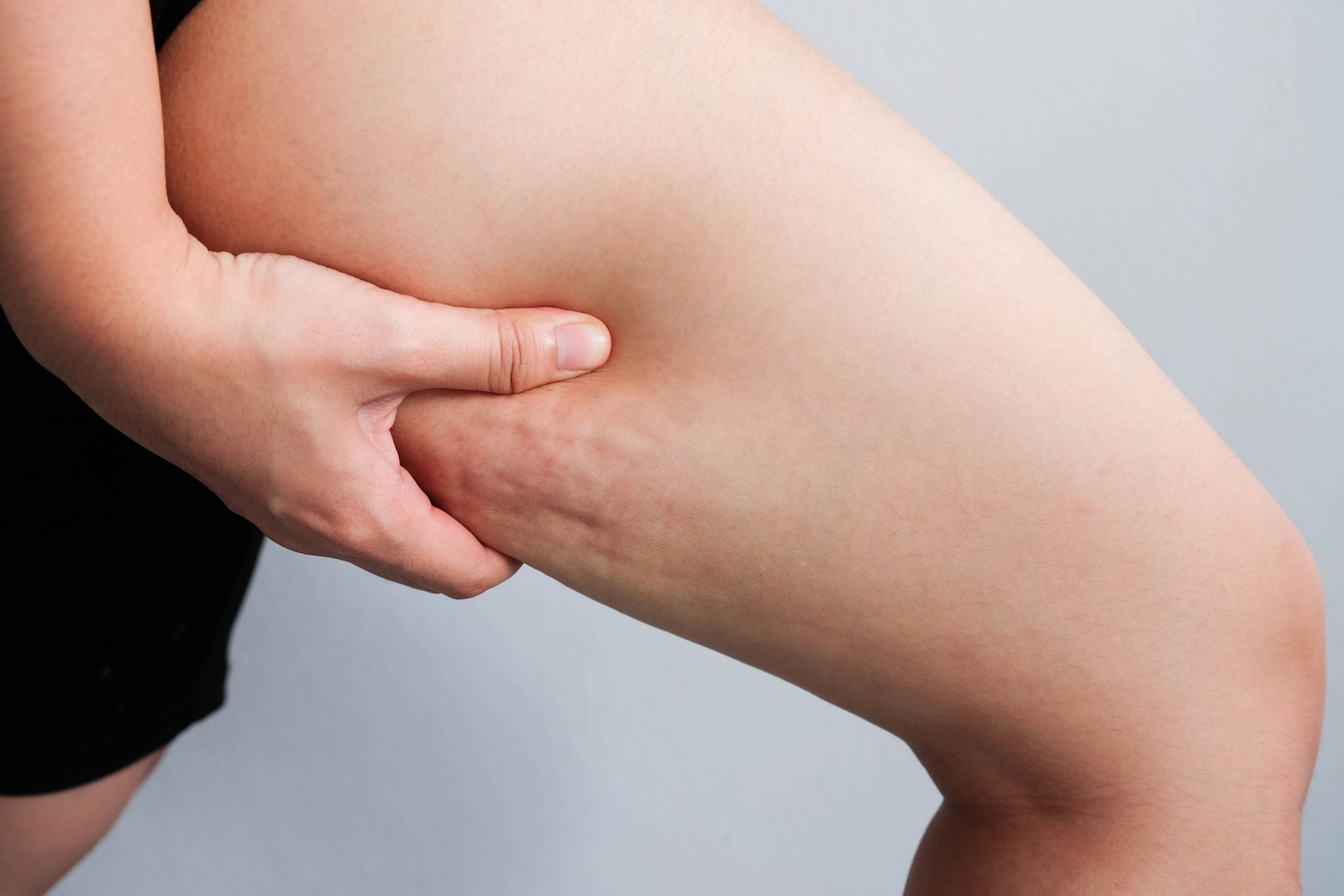 Female legs thighs with cellulite. Skin problem, body care, overweight and dieting concept, diabetic risk factor