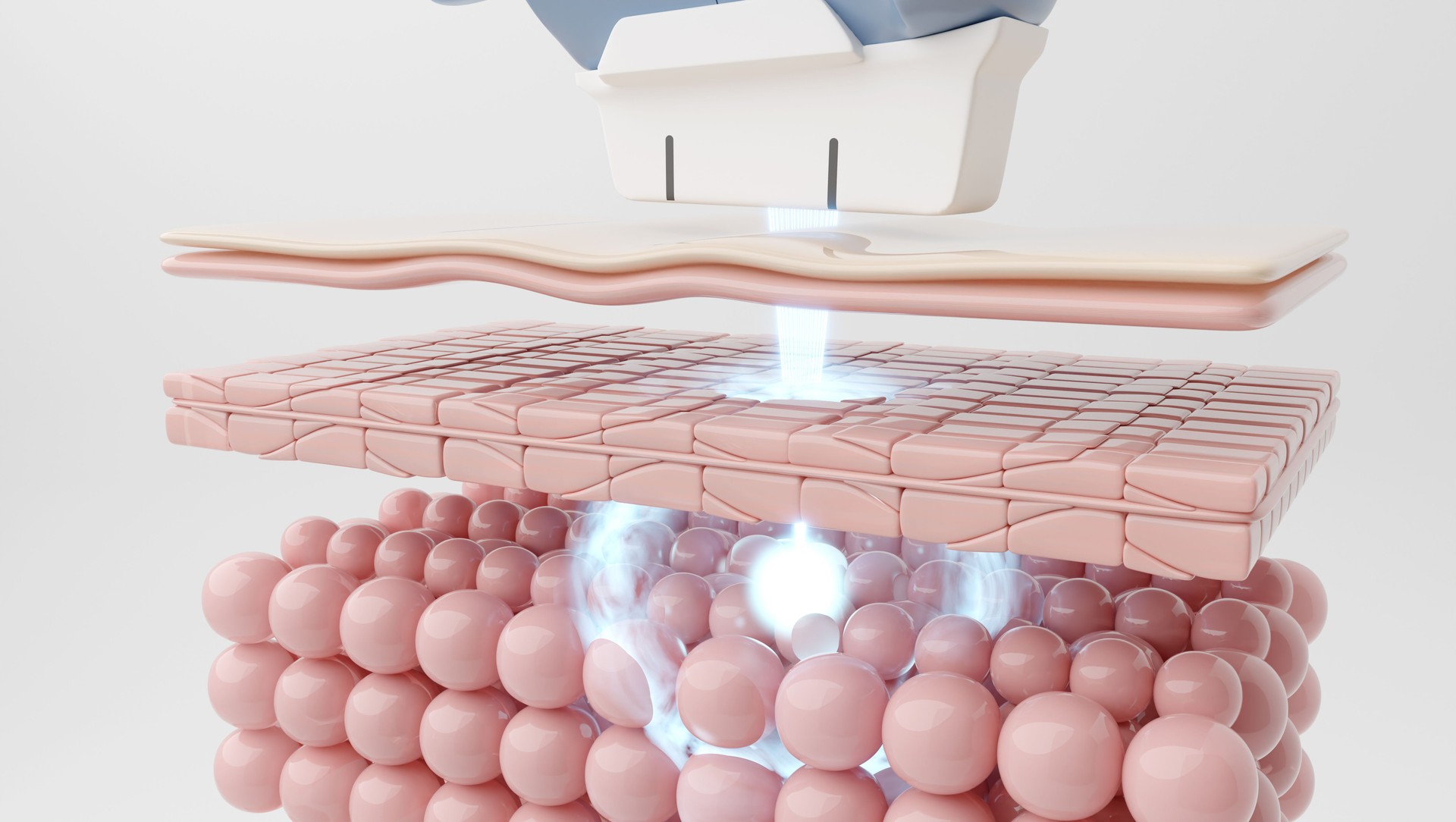 ultherapy laser or HIFU laser penetrating skin to SMAS layer