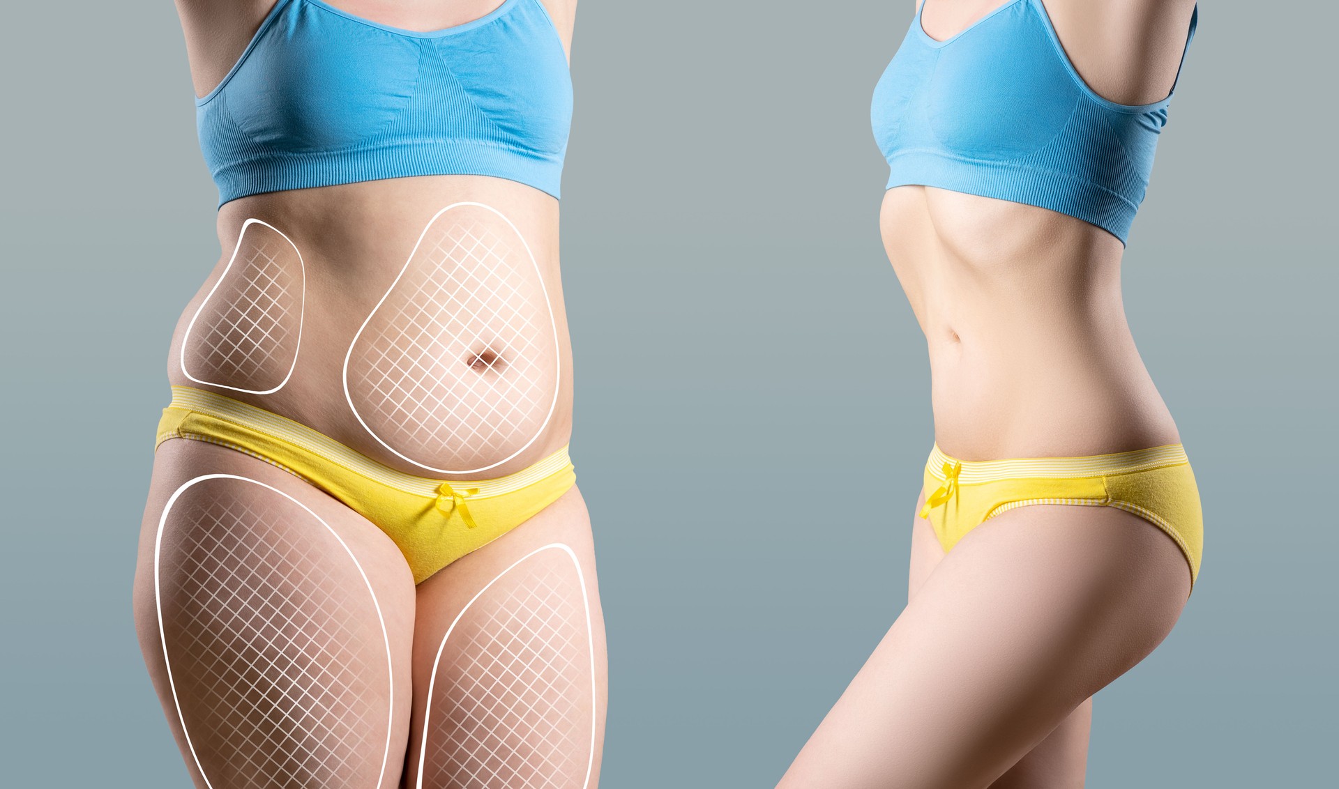 Tummy tuck, cellulite removal, woman's body before and after liposuction on gray background, plastic surgery concept, photos taken at different times after weight loss