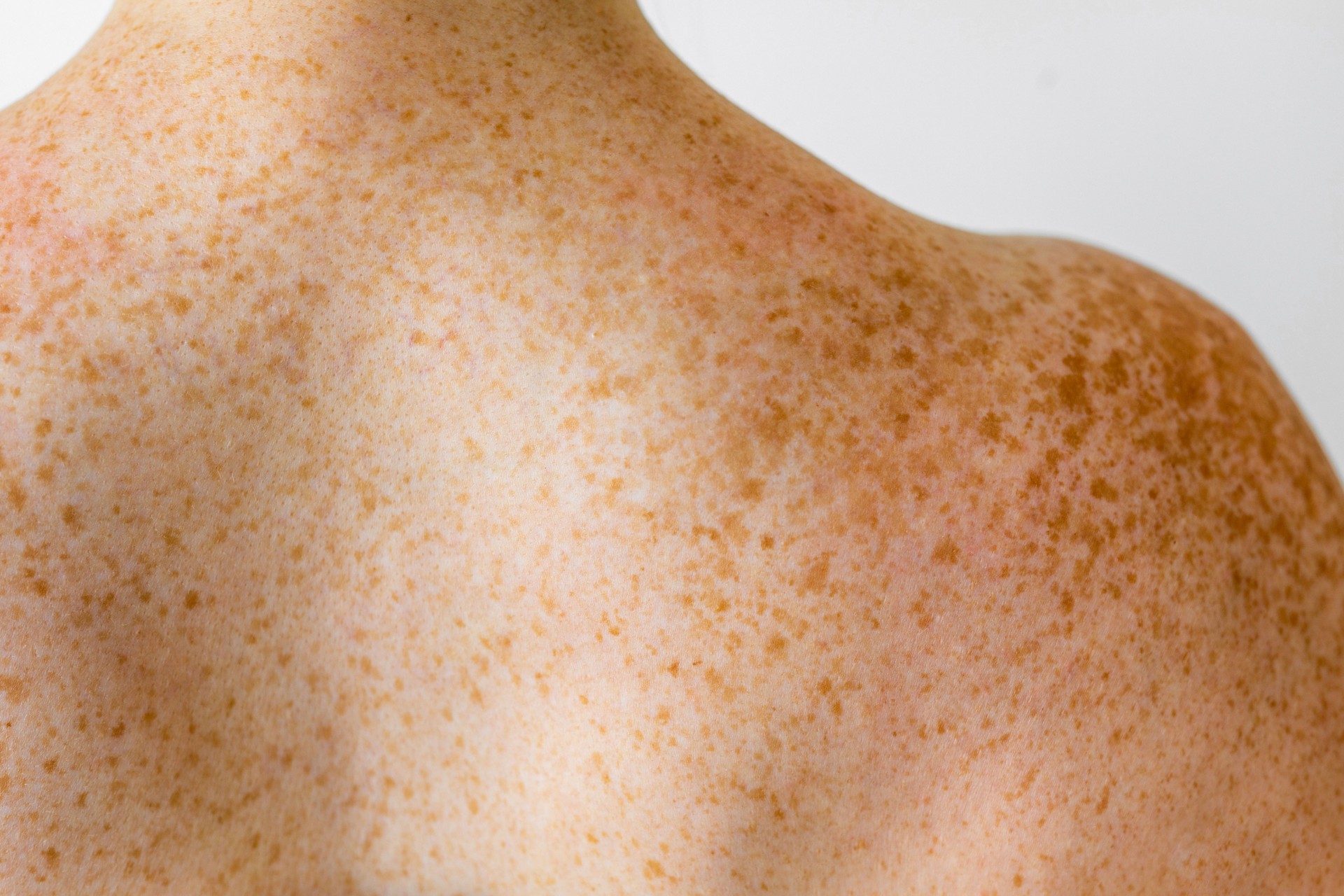 Freckles on back