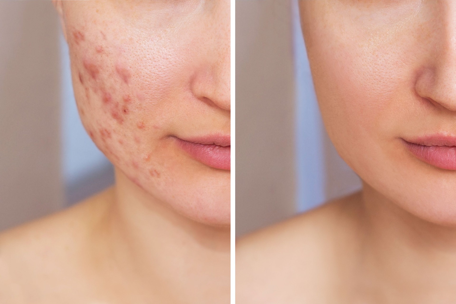 Cropped shot of young woman's face before and after acne treatment. Problem skin, pimples, red scars