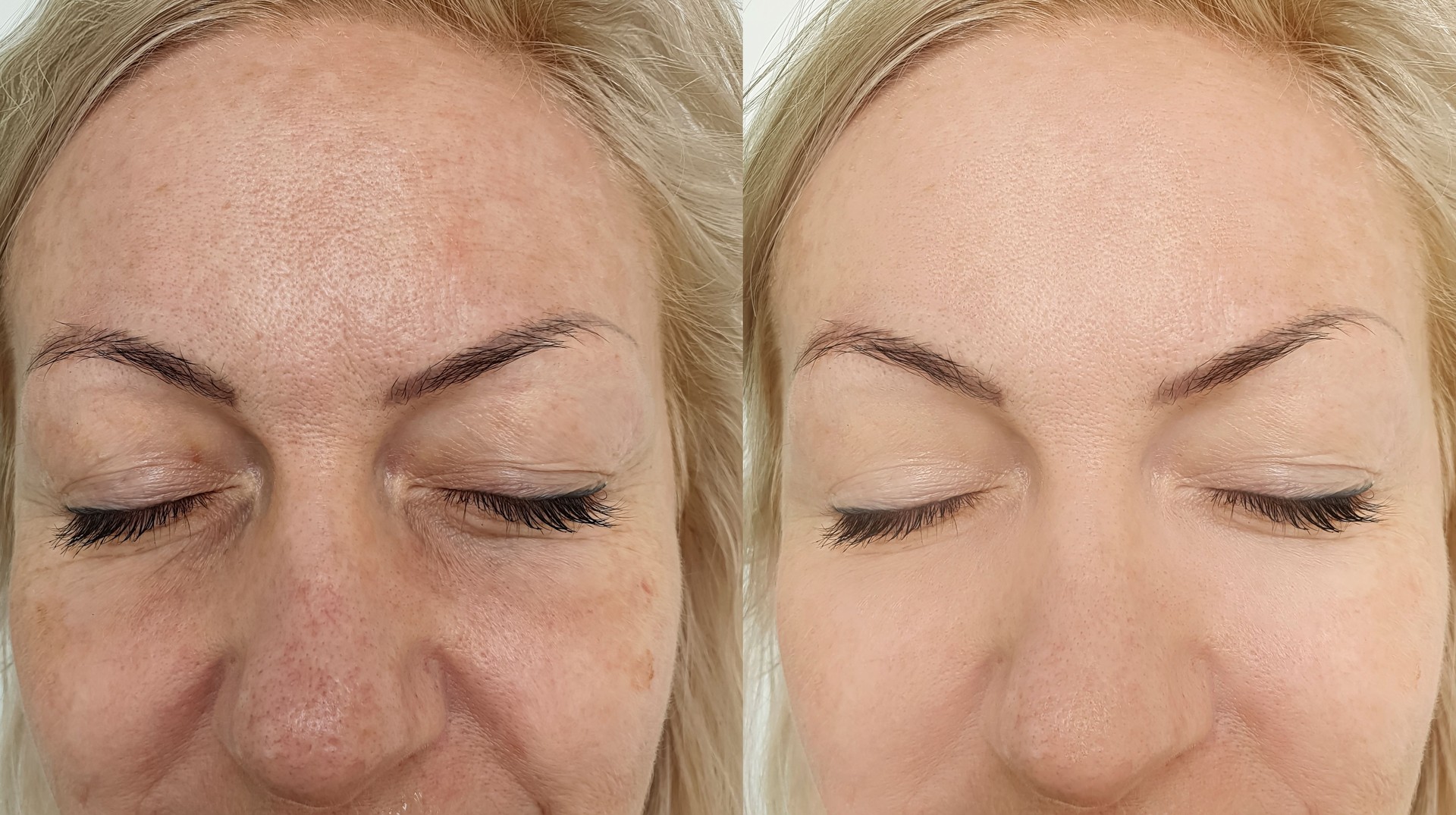 woman face wrinkles before and after collage treatment