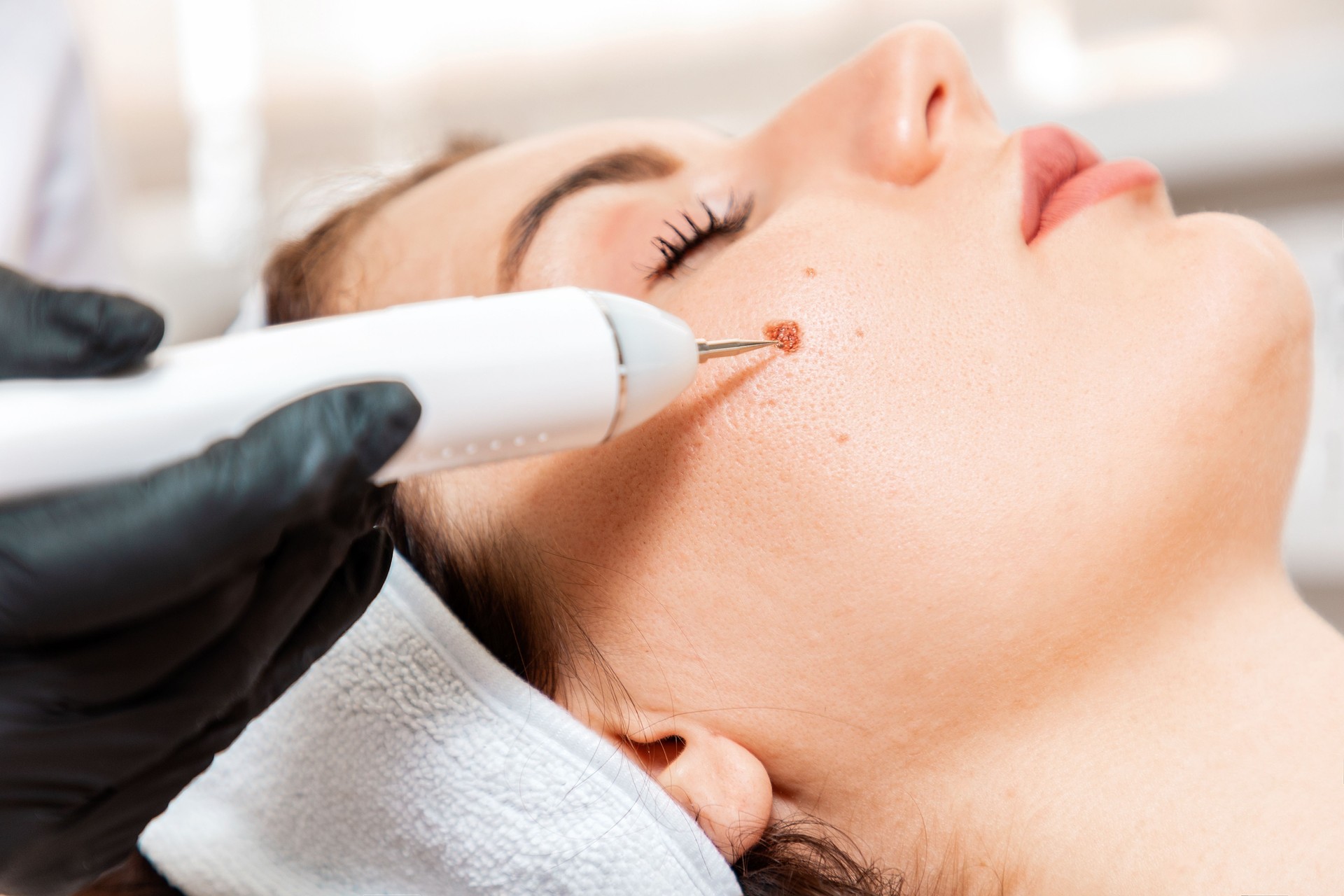 Professional salon procedures. Surgeon using a laser device for removing mole. Removal of birthmark from female face. Close up. Concept of laser cosmelotogy and electrocoagulation