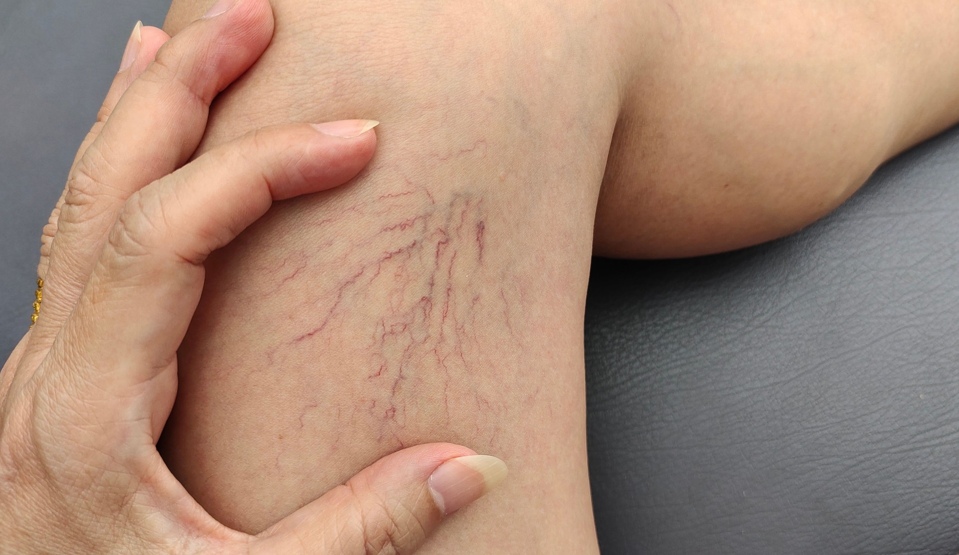The varicose veins on the leg.